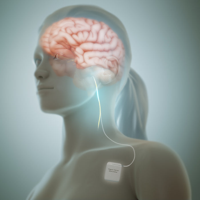 Vagus Nerve Stimulation: A Comprehensive Guide for Managing Depression